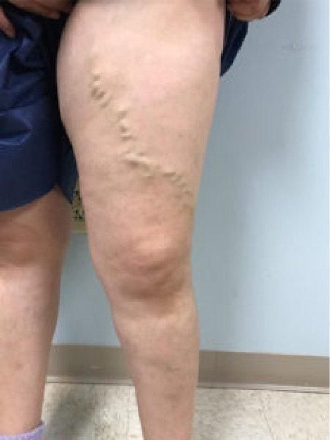 A woman 's leg with varicose veins on it.