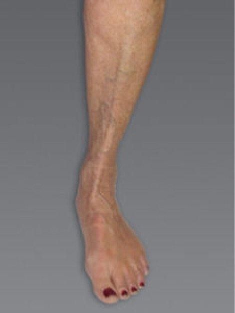 A woman 's leg with a scar on it and red nails.