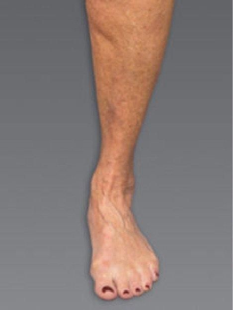 A close up of a person 's foot on a gray background.