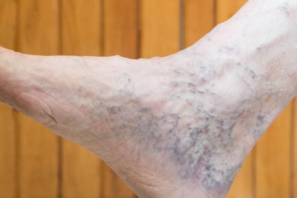 A close up of a person 's foot with varicose veins.