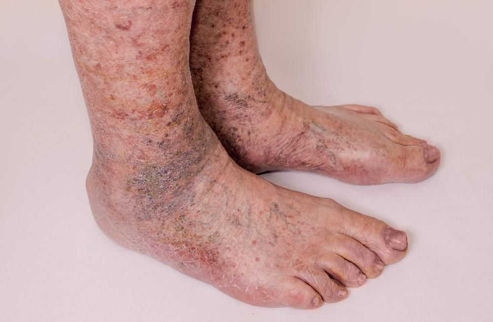 A close up of a person 's legs with varicose veins.