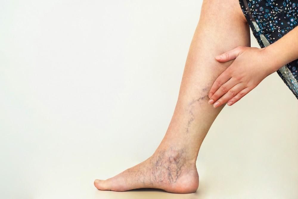 A woman is sitting down and touching her leg with varicose veins.