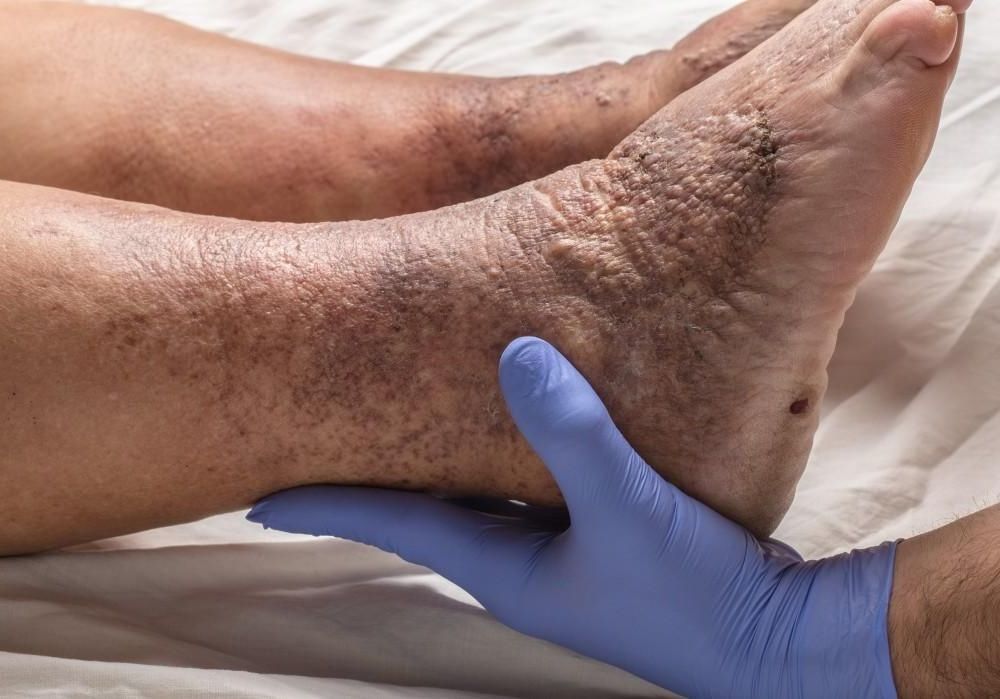 A doctor is examining a patient 's leg with varicose veins.