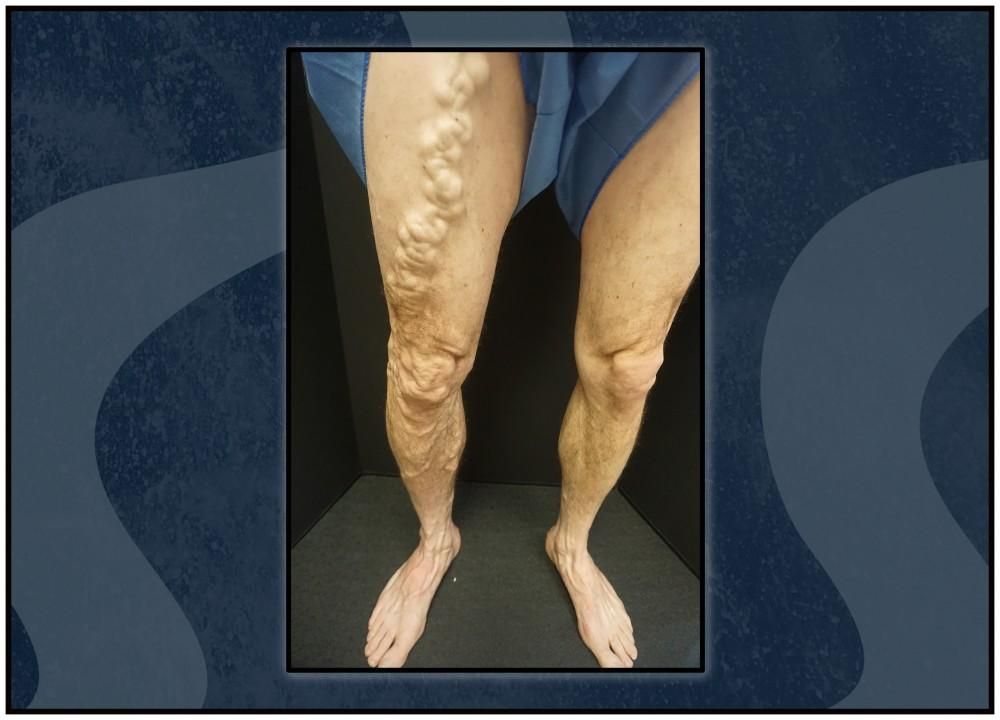 A picture of a person 's legs with varicose veins.