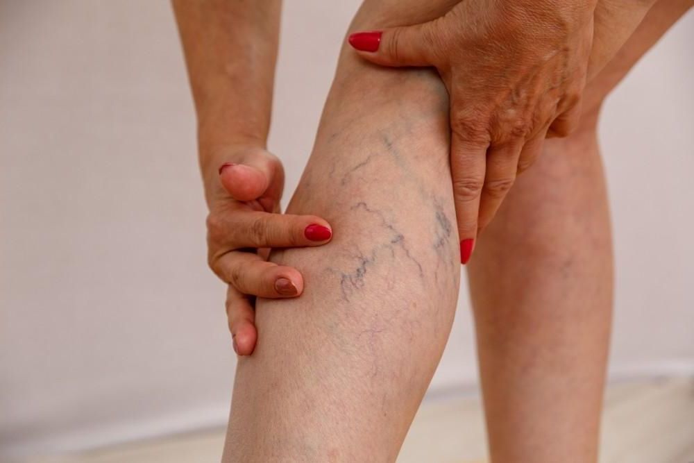 A woman with red nails is holding her leg with varicose veins.