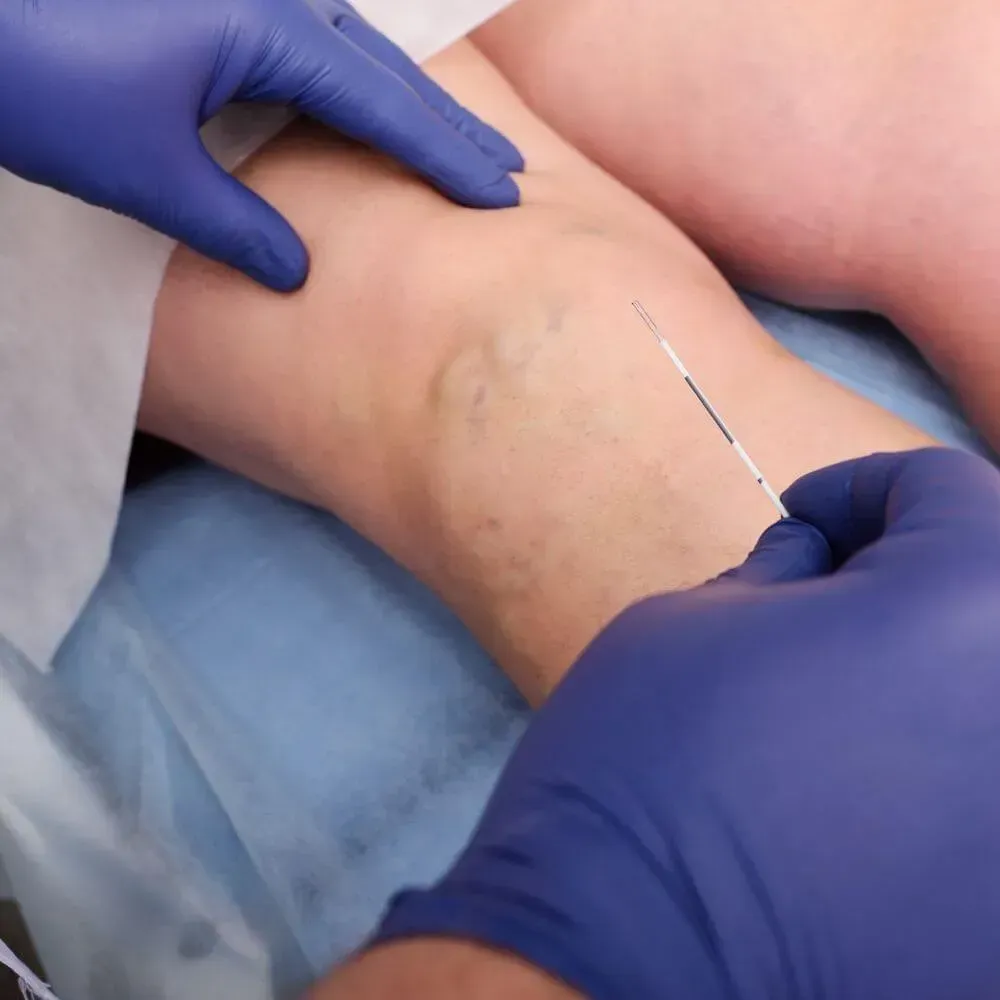 A person wearing blue gloves is getting a needle in their leg