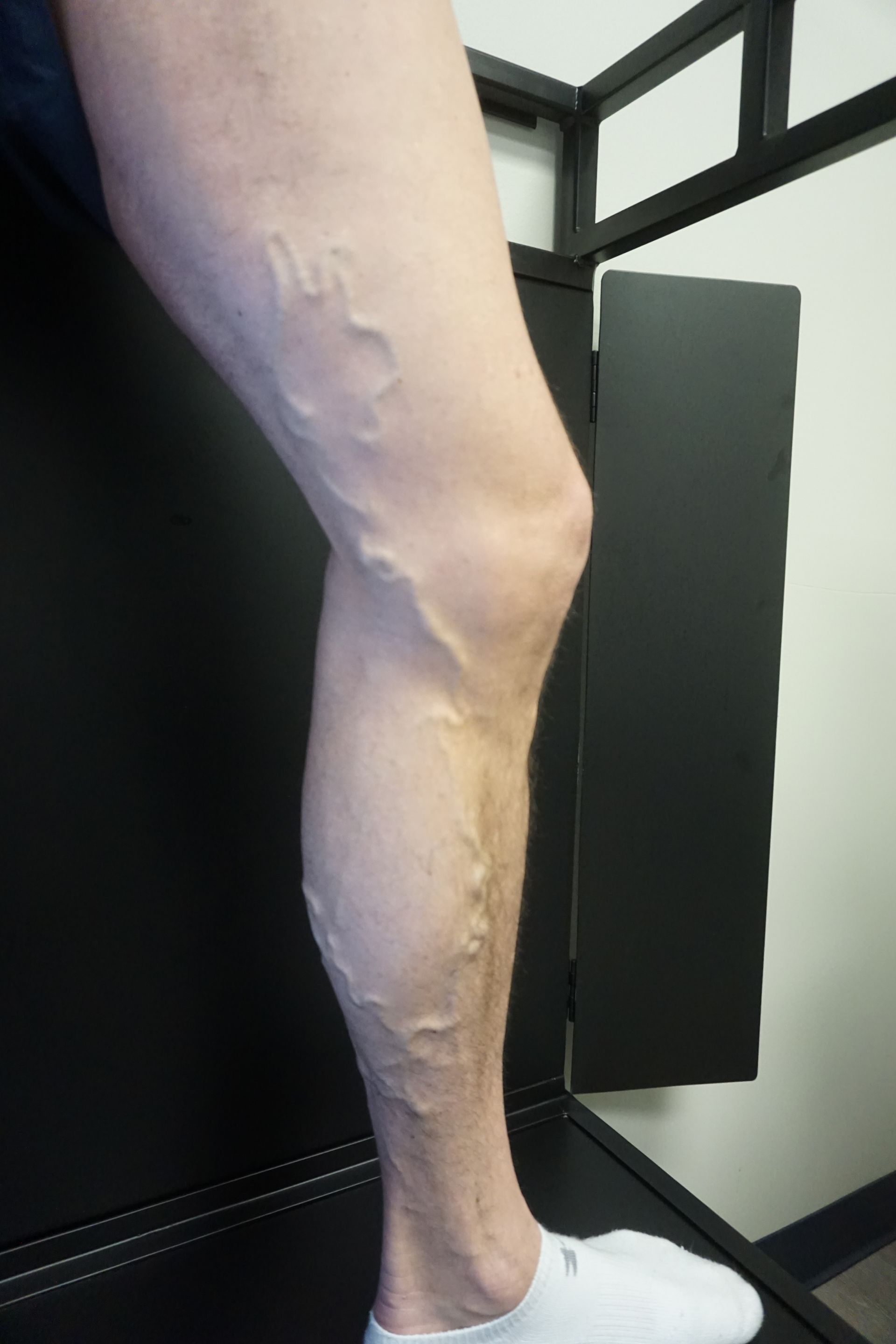 A person with varicose veins on their legs