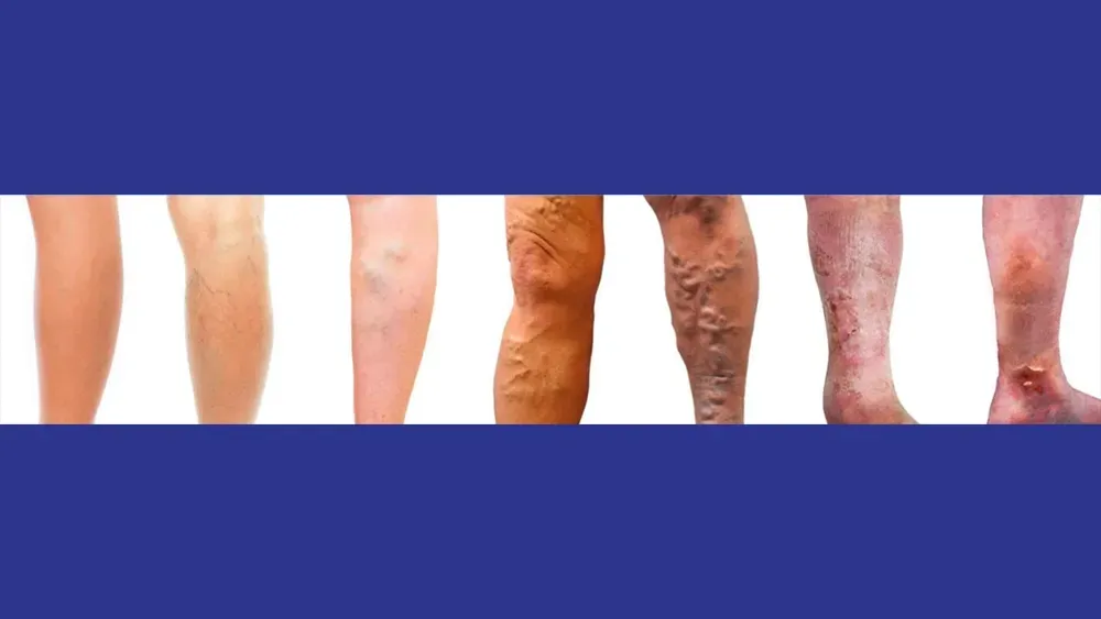 Chronic Venous Insufficiency