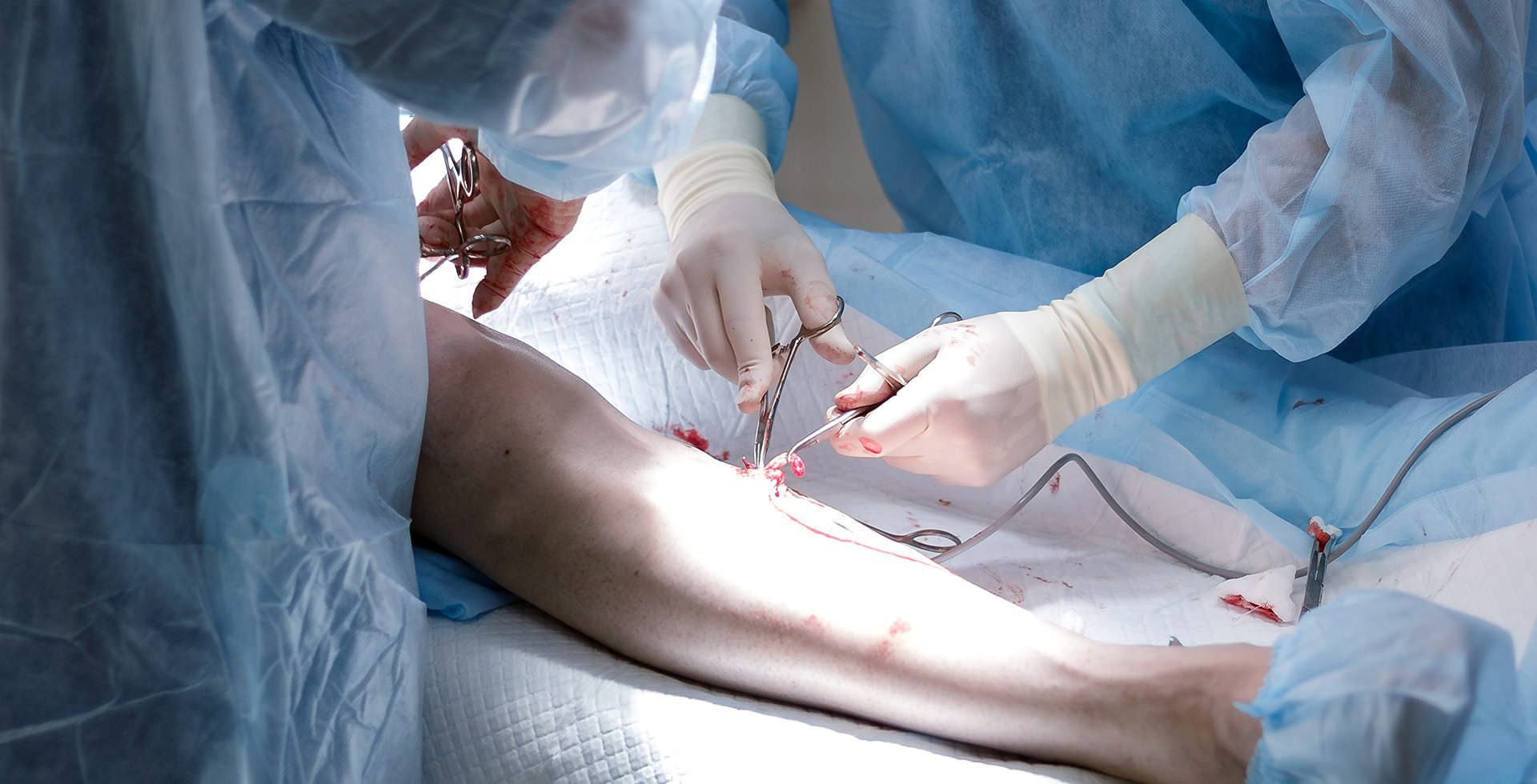 A group of surgeons are operating on a patient 's leg.