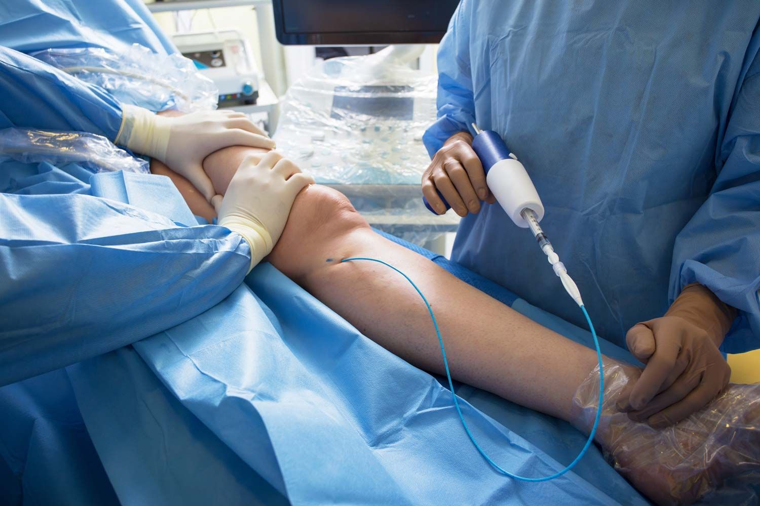A surgeon is performing a vein surgery on a patient 's leg.