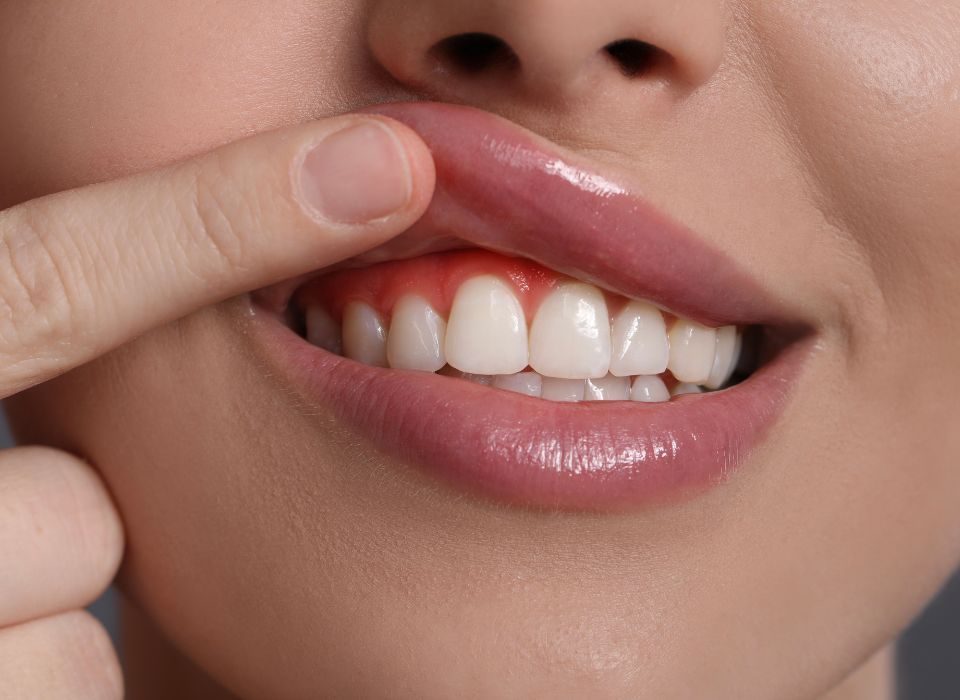 Person's lips and gums. Finger pulls up lip, revealing red, inflamed gums, white teeth.