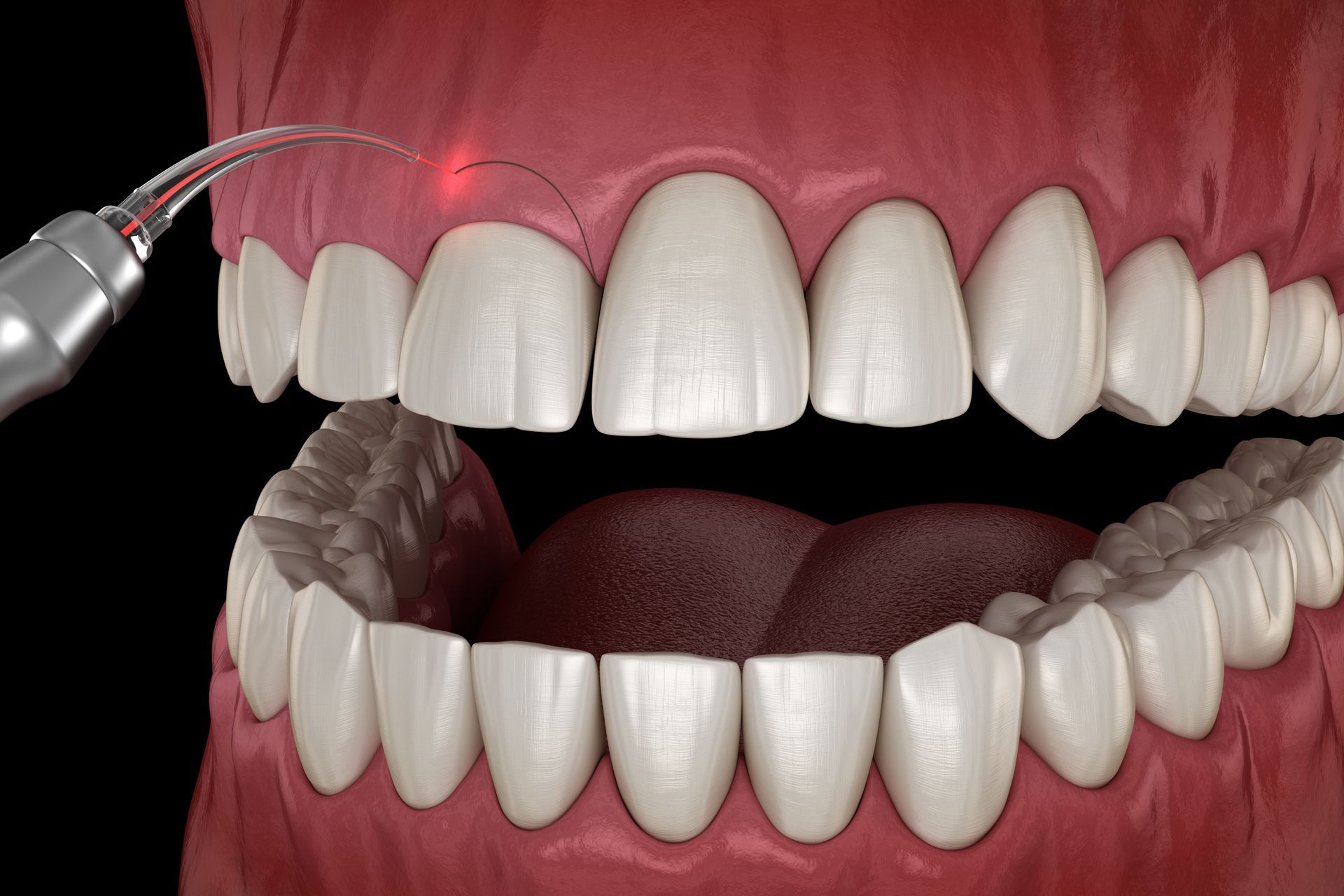 Dental laser being used on the gums around the front teeth; mouth open with teeth visible; red laser light.
