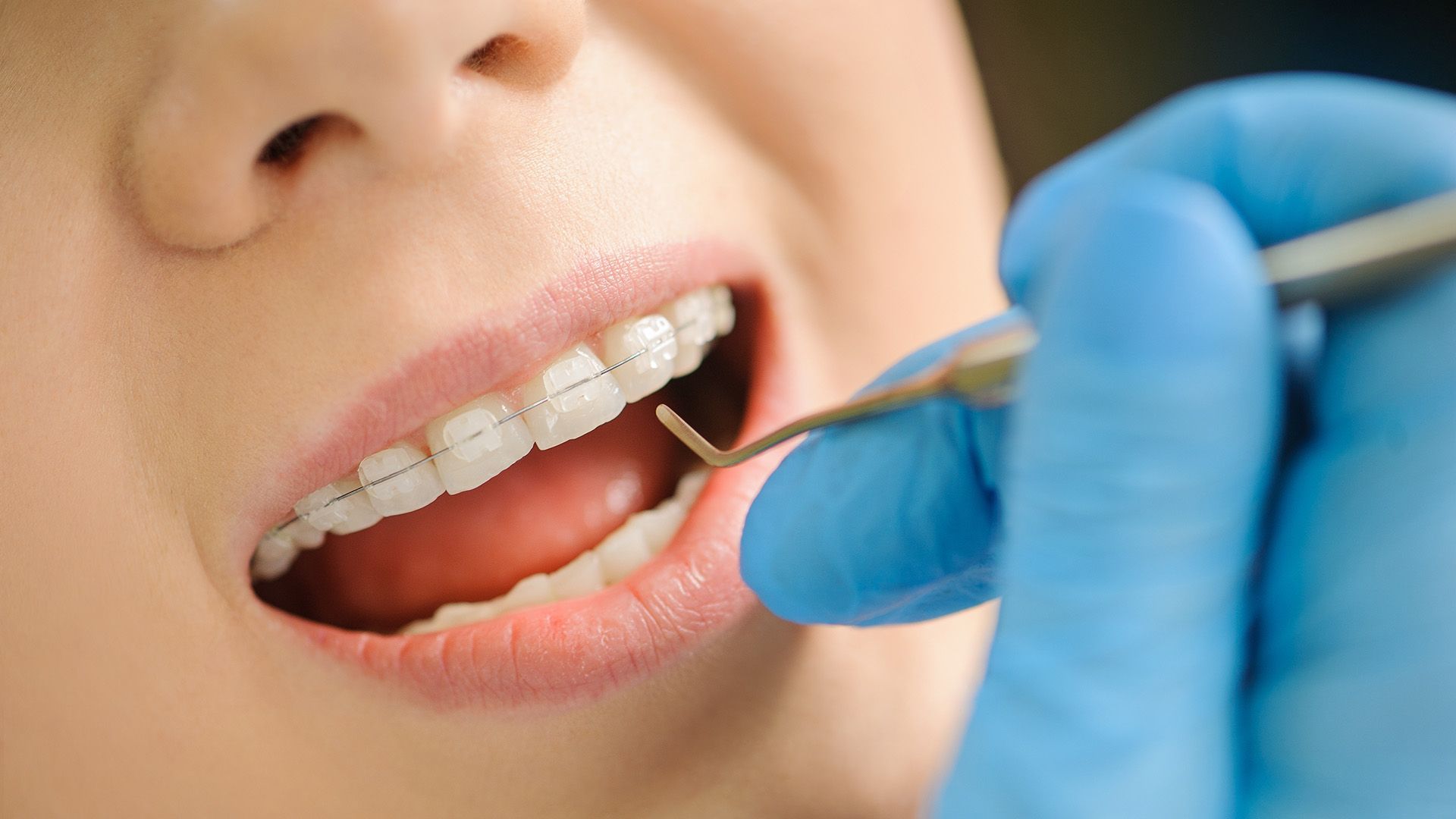 Can You Get Your Teeth Cleaned with Braces?
