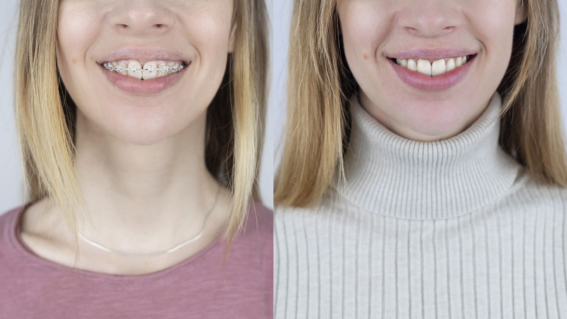 How Long Do You Have to Wear Braces? 