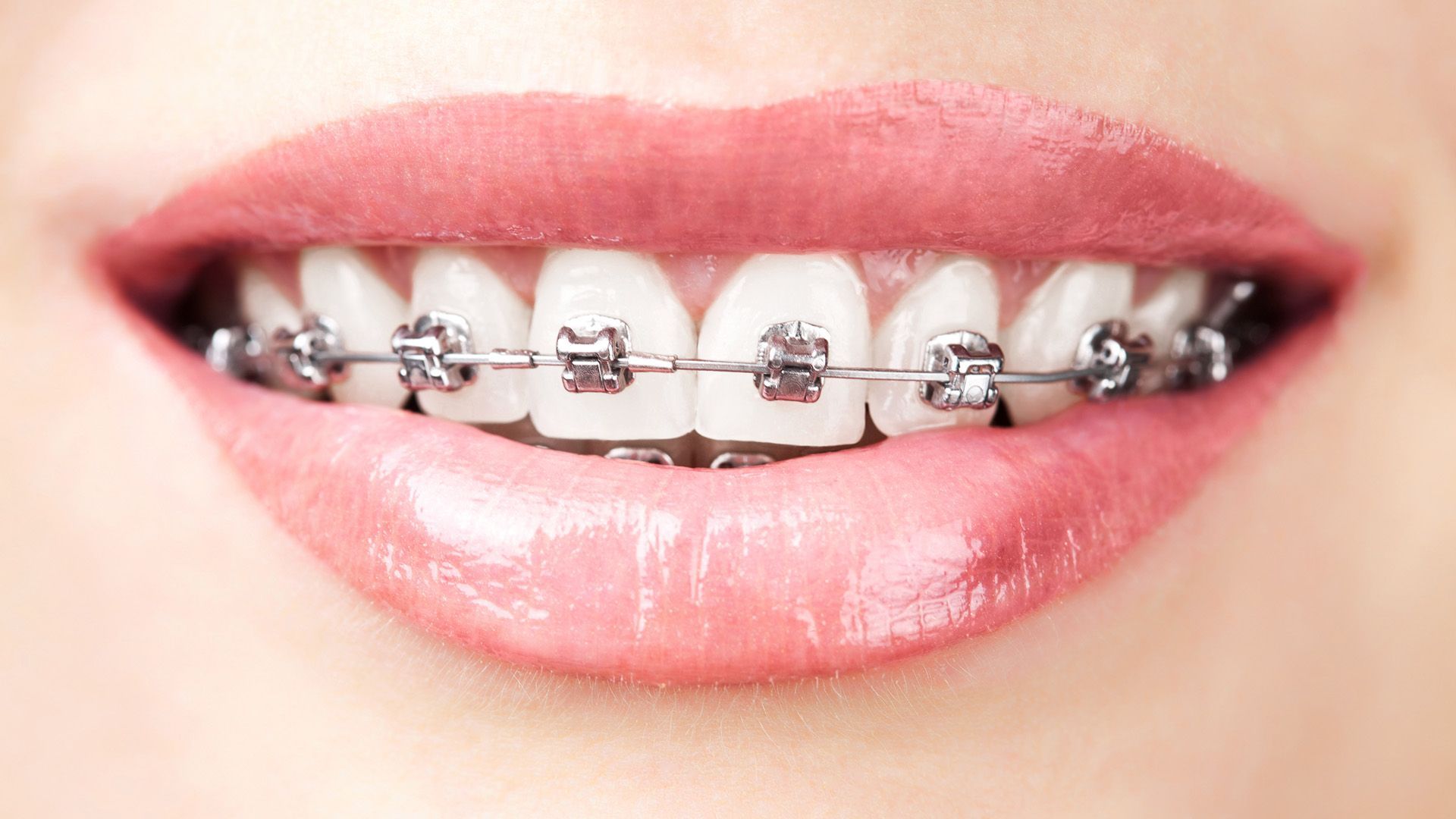 How to Handle Braces Pain Without Medication