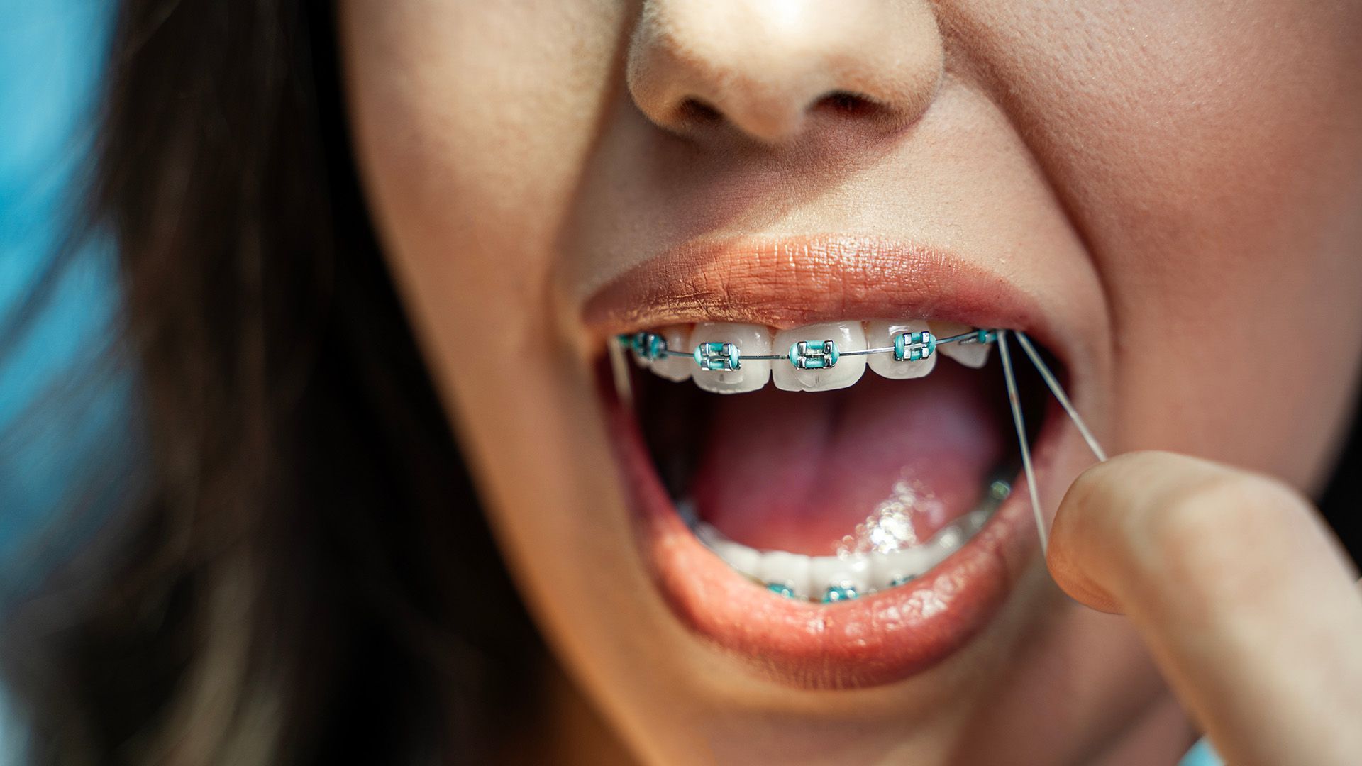 How to Put Rubber Bands On Braces