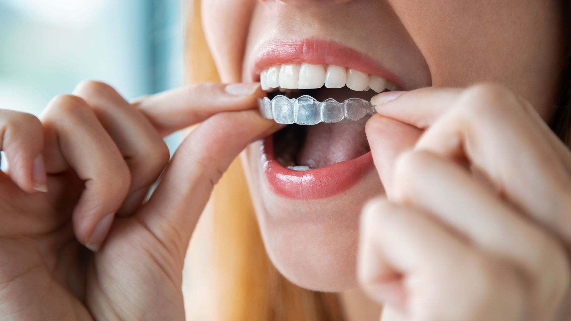 Is Invisalign Cheaper Than Braces?