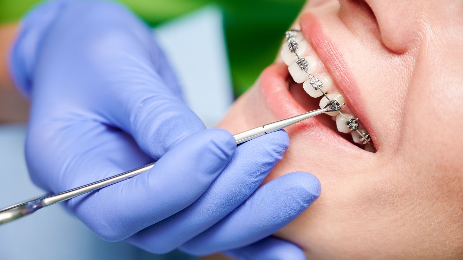 Types of Orthodontic Brackets