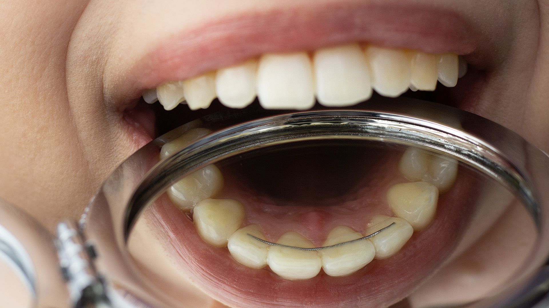 What Is a Permanent Retainer? Benefits, Care, and Costs