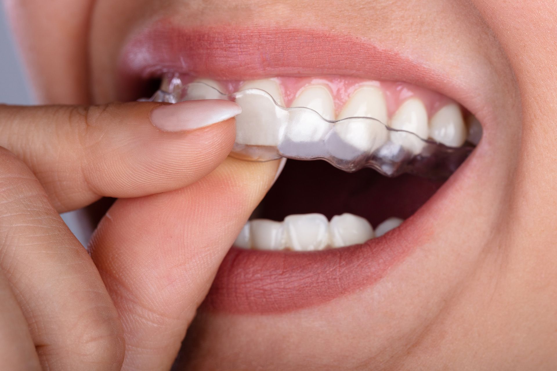 What to know about clear aligners, aligners pros and cons, what are clear aligners and teeth aligner