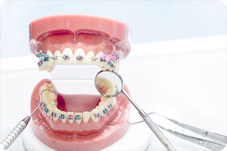 How much do teeth braces cost? How much does it cost for braces? How expensive are braces?