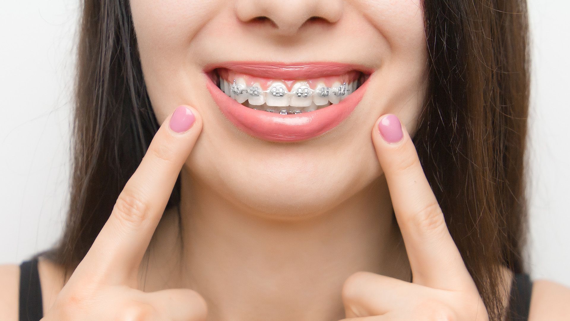 What are self ligating braces?