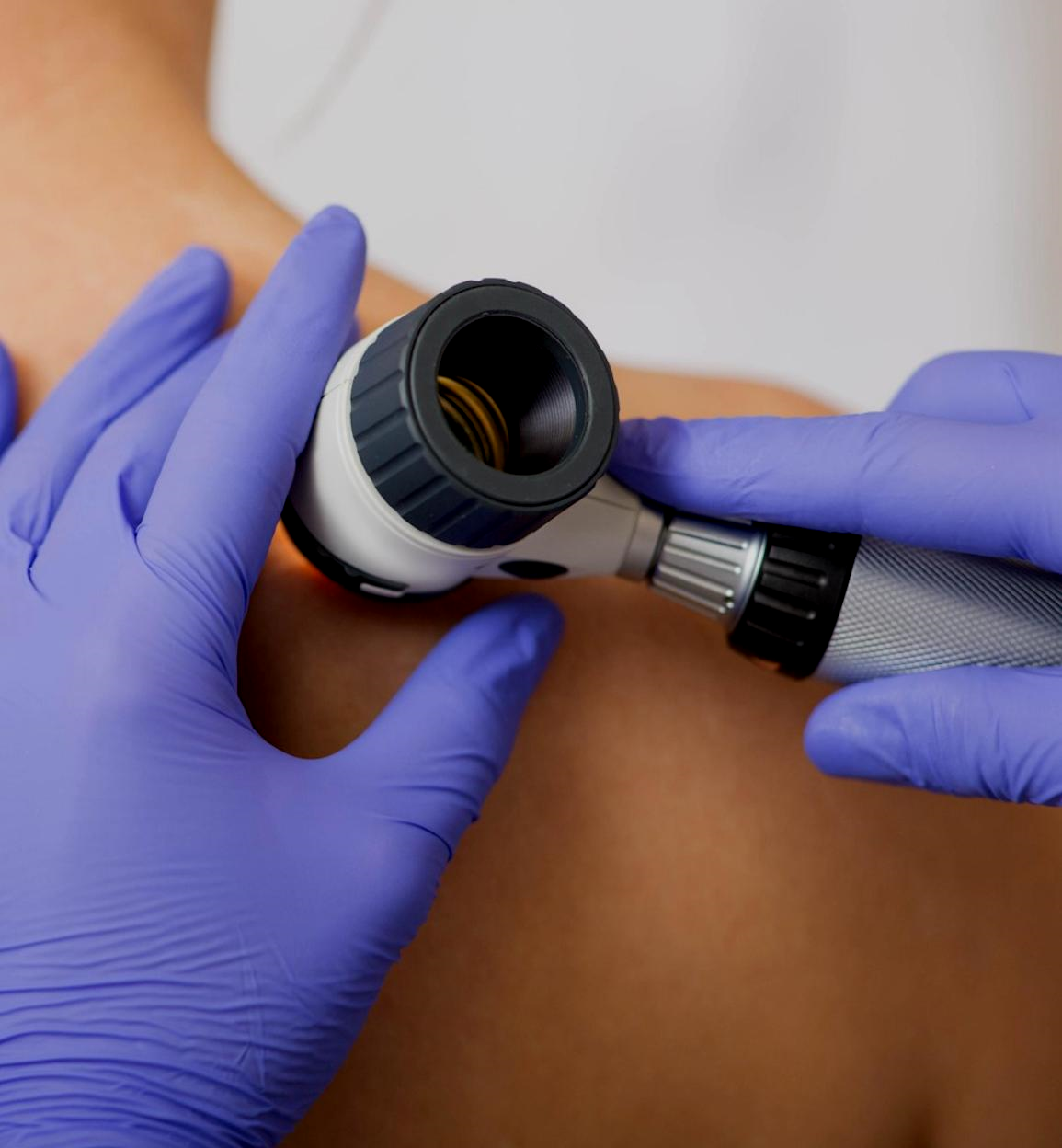Doctor's gloved hands using a dermatoscope on a patient's shoulder, checking skin.