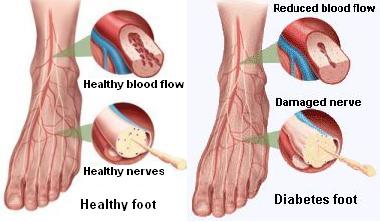 Example of a foot undergoing diabetic podiatry care in Brisbane