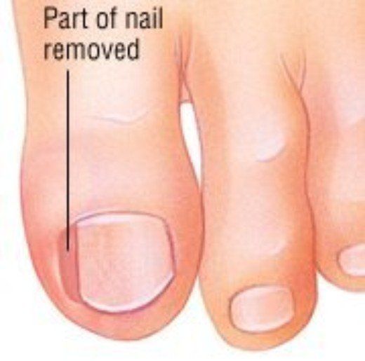 ingrown toenail treatment