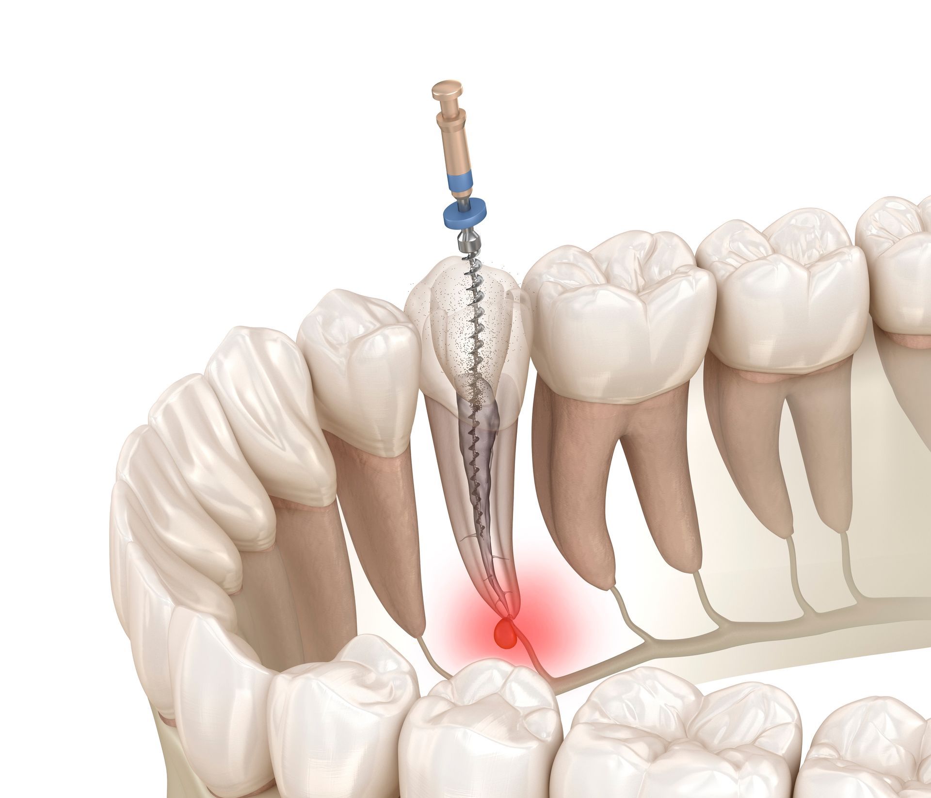 Ritrattare i canali è importante per salvare i denti