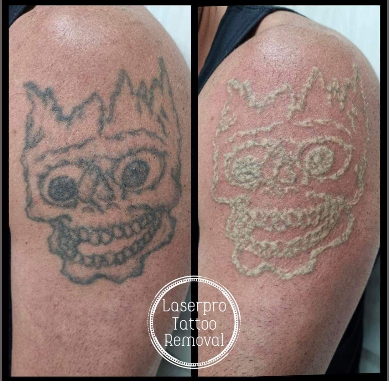 Newly Removed Tattoo on Arm — Removing Tattoos in Shellharbour, NSW