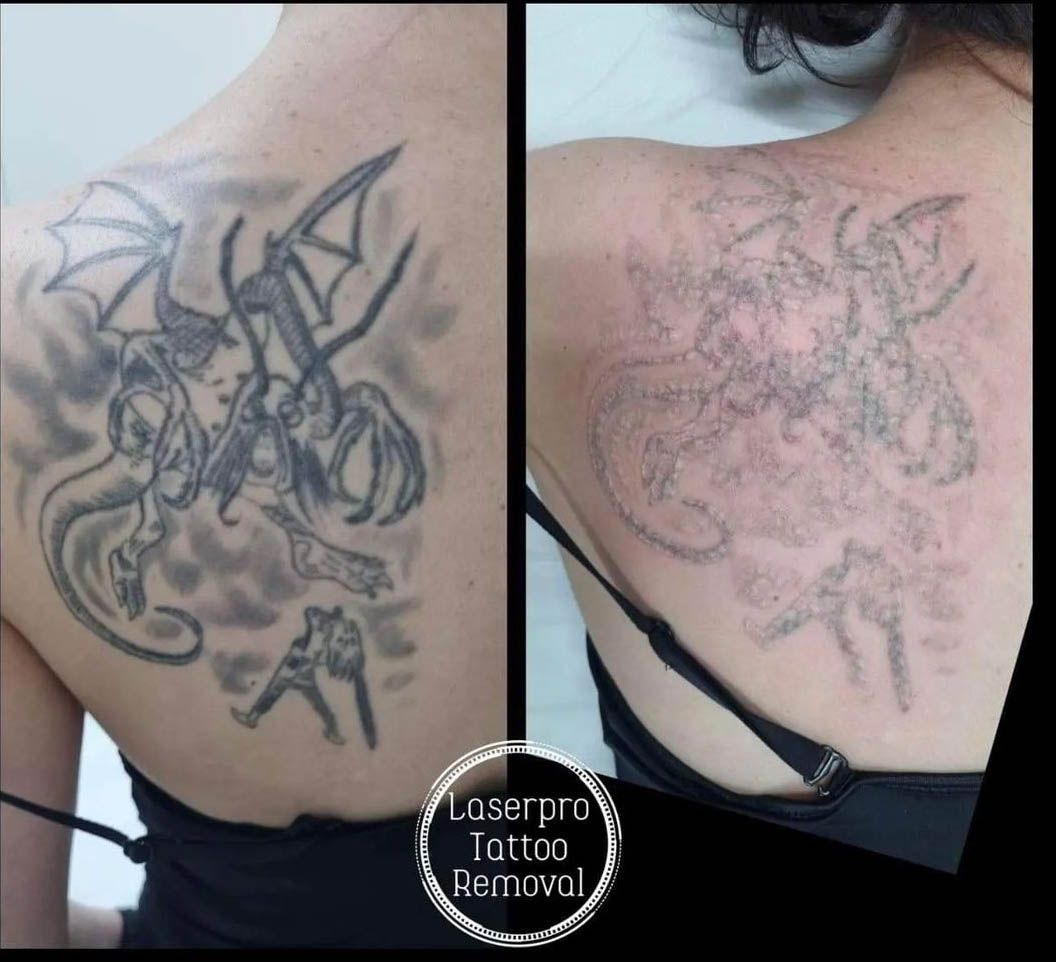 Back Tattoo Removal — Removing Tattoos in Shellharbour, NSW