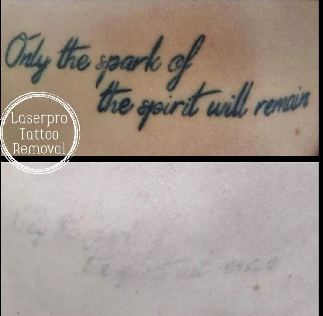 Before and After of Skin Tattoo Removal — Removing Tattoos in Shellharbour, NSW