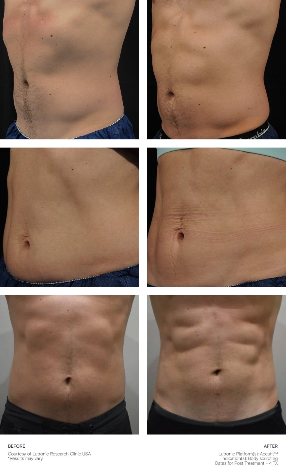 A collage of four pictures of a man 's stomach before and after a surgery.