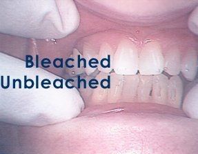 Bleached - Galloway, NJ - Asuncion Family Dental