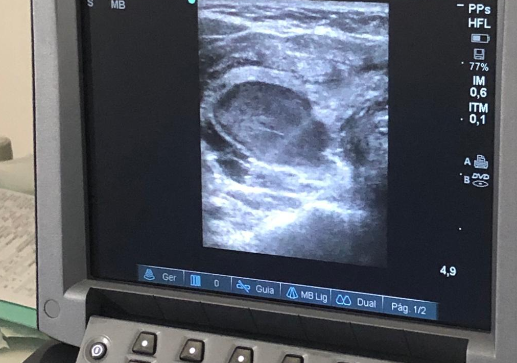 Como funciona a Ablação de Nódulos de Tireoide Como funciona a Ablação de Nódulos de Tireoide?