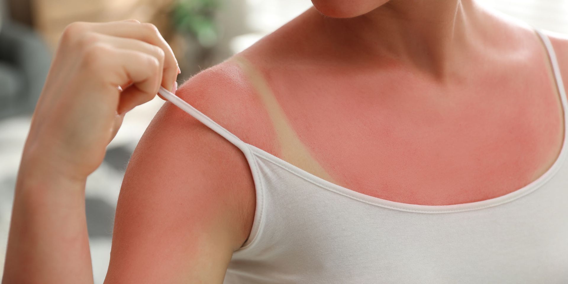 5 Natural Ways to Prevent Sunburns