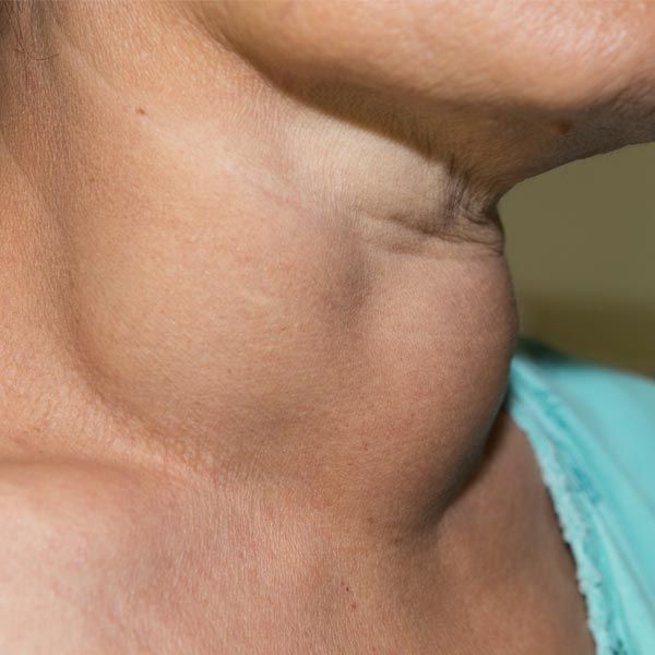 Woman with a Goiter from Hashimoto's Thyroiditis