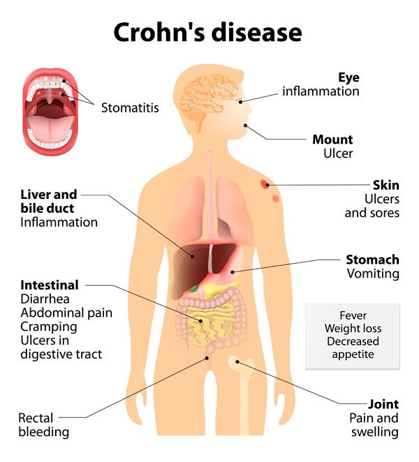 Symptoms of Crohn's Disease and Causes of Crohn's Disease
