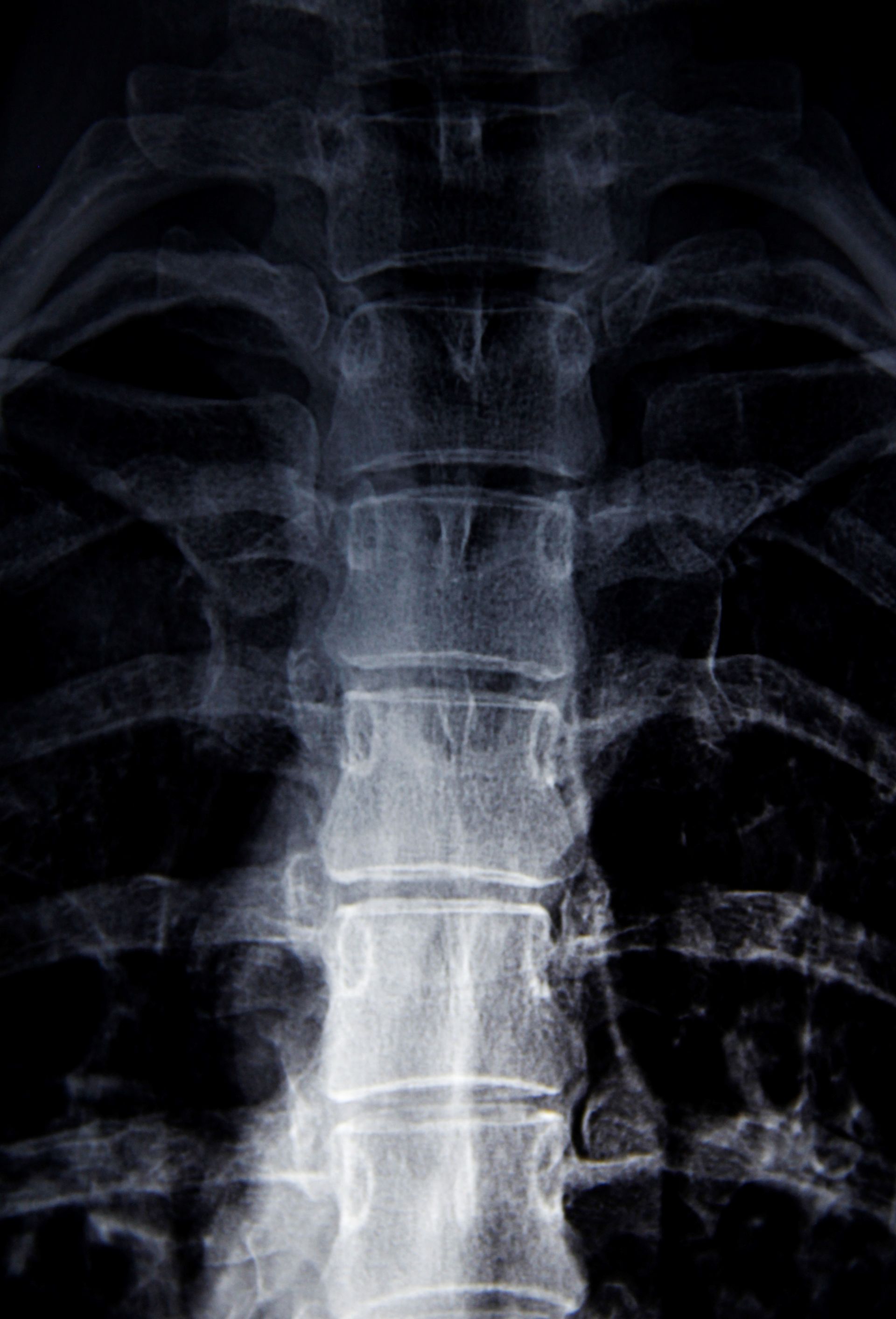 X-ray of the human spine and rib cage, showing the vertebral column and surrounding bones.