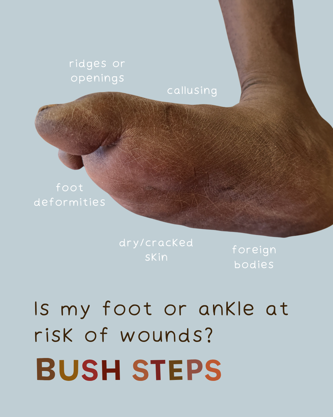 Foot with labeled areas like calluses and dry skin, promoting foot wound risk awareness,