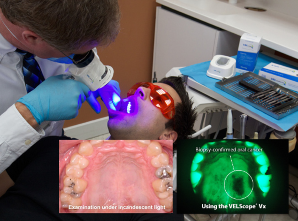 biopsia cavo orale