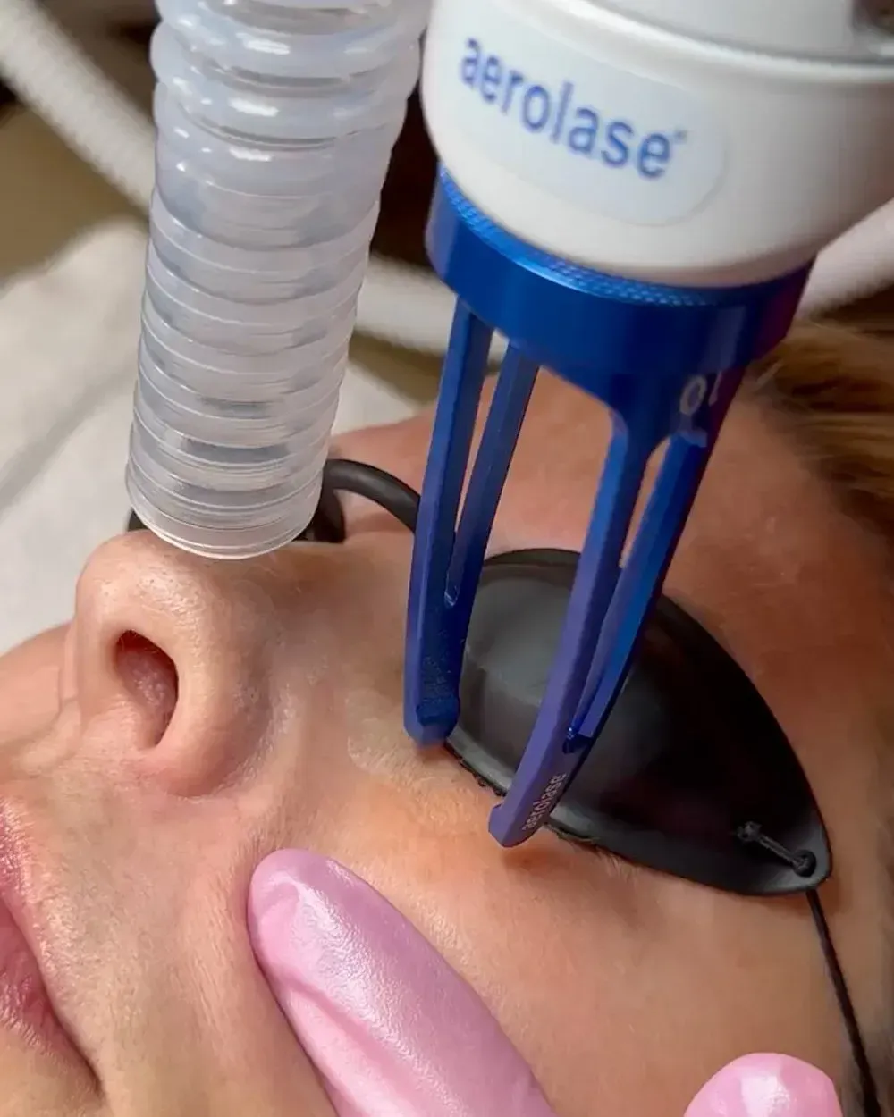 A woman is getting an aerolase treatment on her face