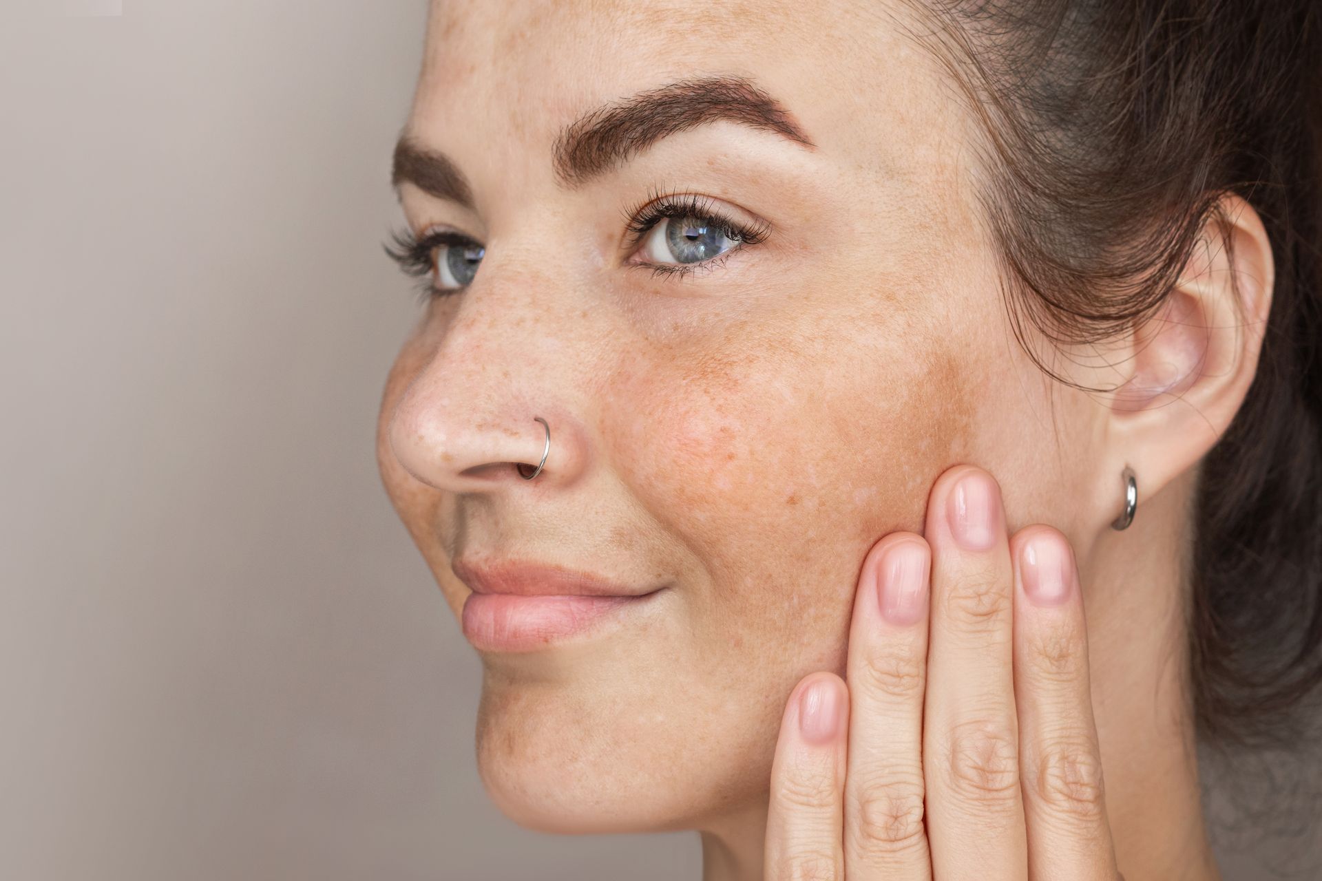 Woman with skin discoloration, touching cheek; light background.