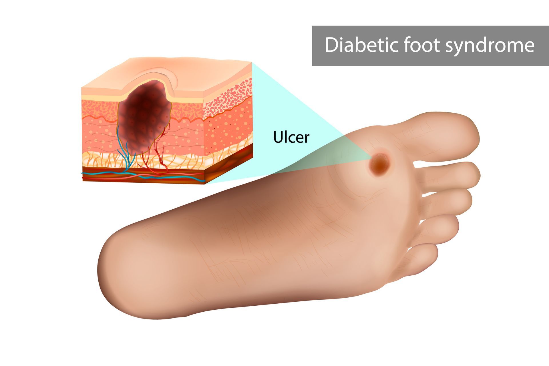 Piede diabetico