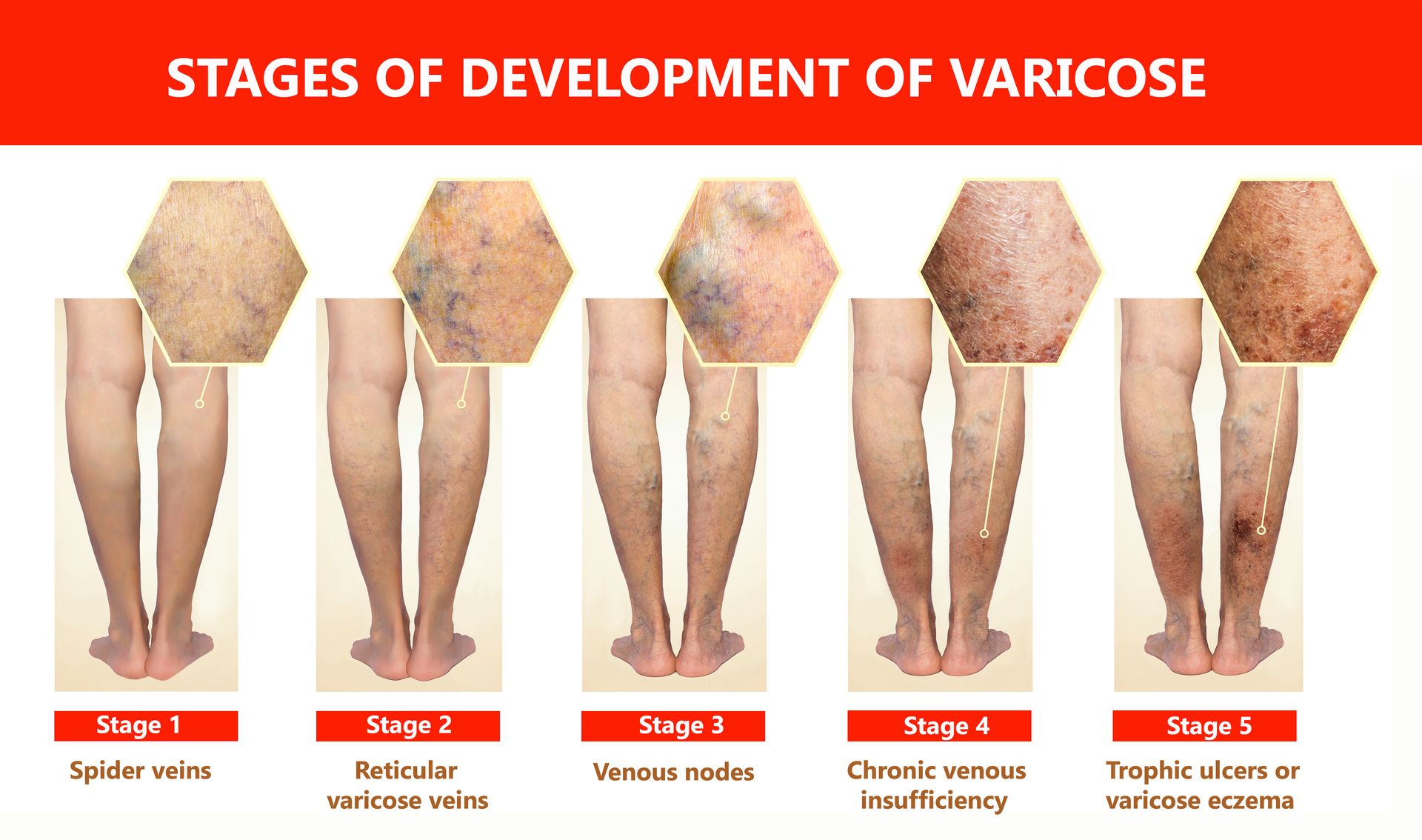 A poster showing the stages of development of varicose veins