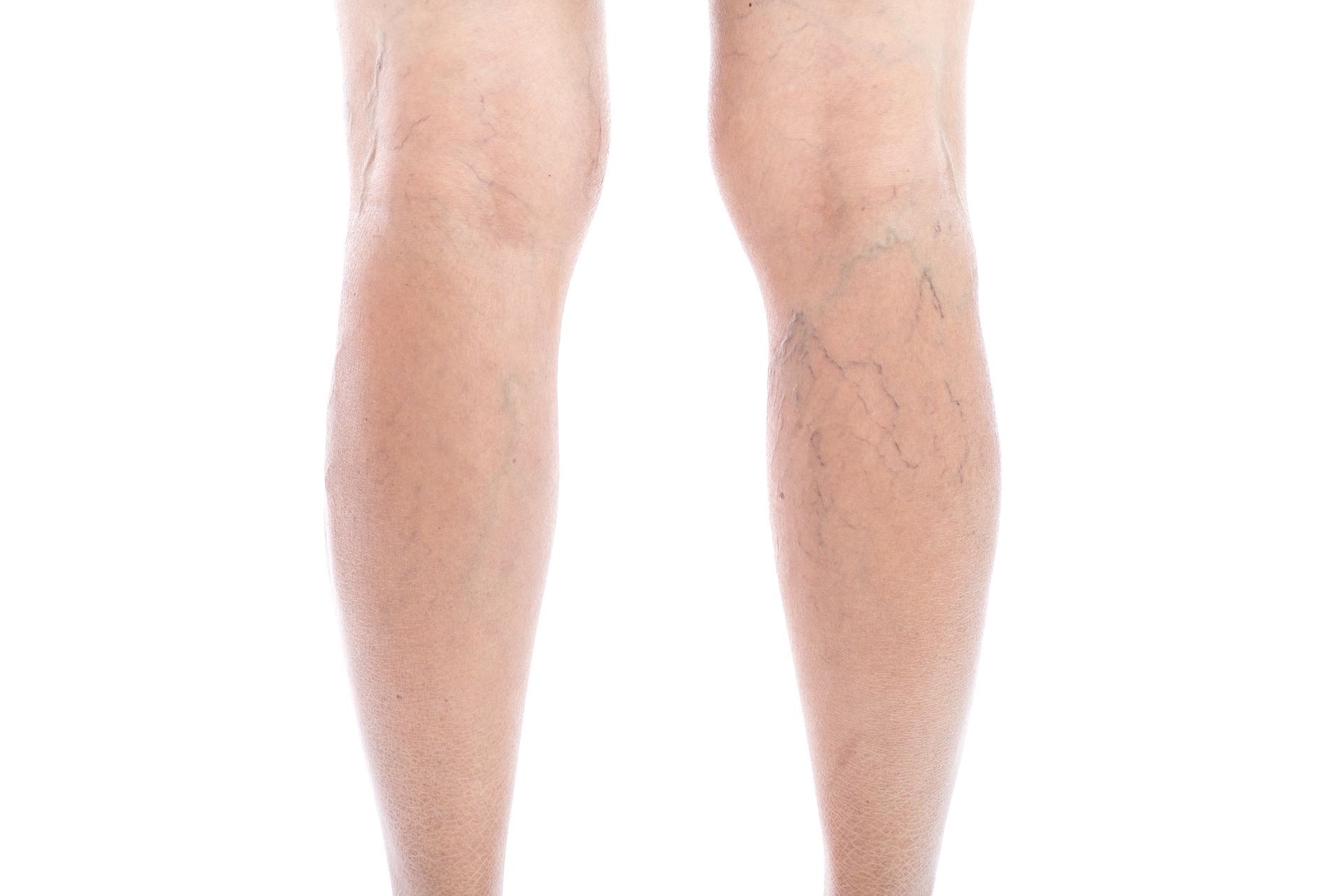 A man 's legs with varicose veins on a white background.