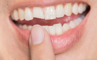 Abgebrochener Schneidezahn: Mit einem sog. Komposit oder einem Keramik-Veneer kann der Zahn wiederhergestellt werden.