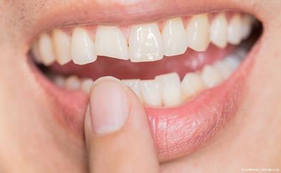 Ein konfektionierter Sport-Gebissschutz schützt die Zähne nicht immer vor Verletzungen.