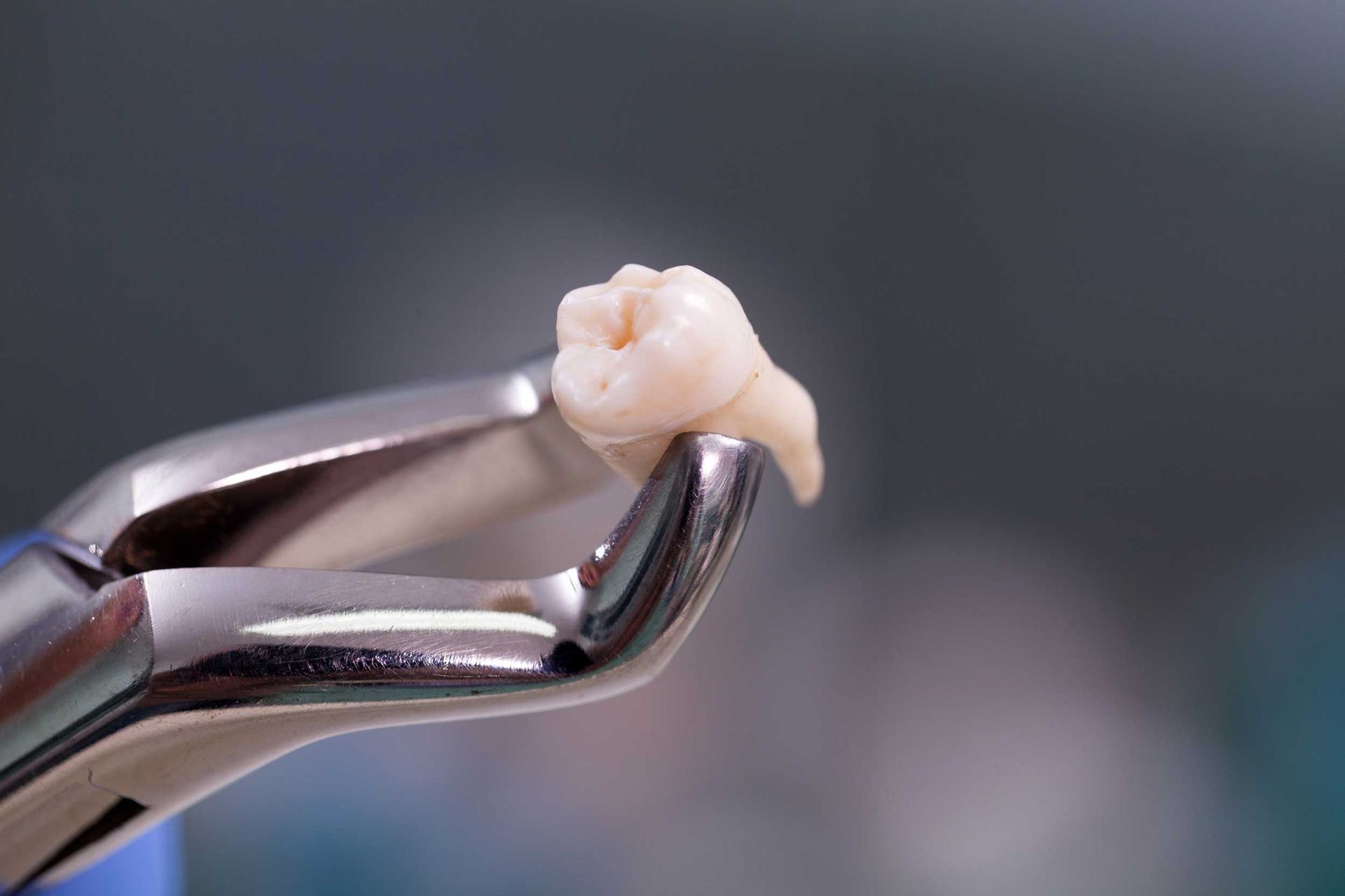 An extracted molar tooth held with dental forceps in a close-up view An extracted molar tooth held with dental forceps in a close-up view